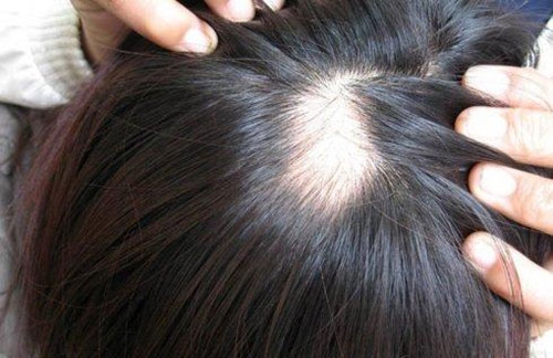 女性总是掉头发严重是什么原因？