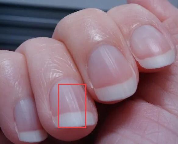 指甲上有竖纹是身体反馈什么信号.jpg